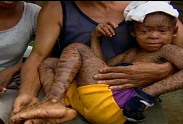 Niño con piel de culebra
