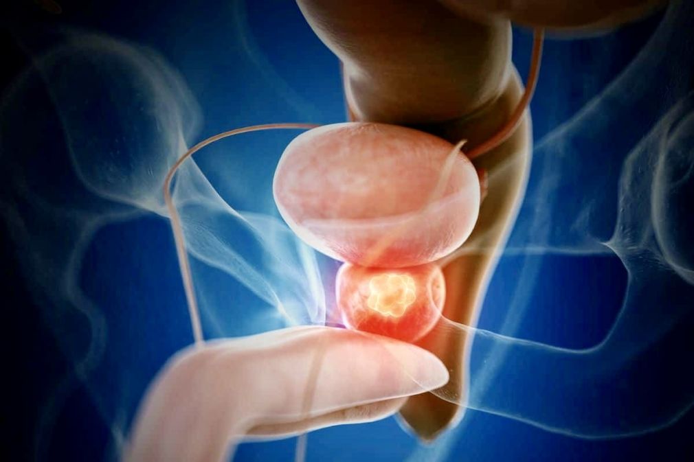 El Día Nacional de la Concientización y Lucha contra el Cáncer de Próstata se conmemora cada 19 de noviembre.