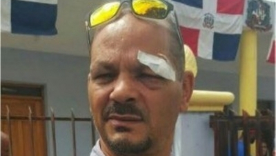 Alcalde de Monción es herido por agentes policiales en la cara: 