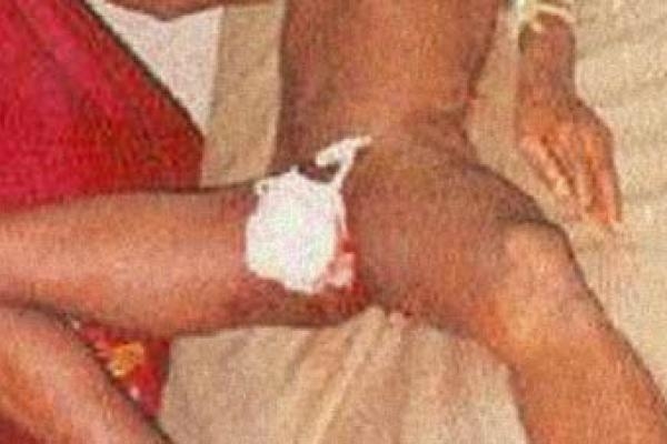 Médicos logran salvar pene a hombre se lo cortó porque esposa lo dejó