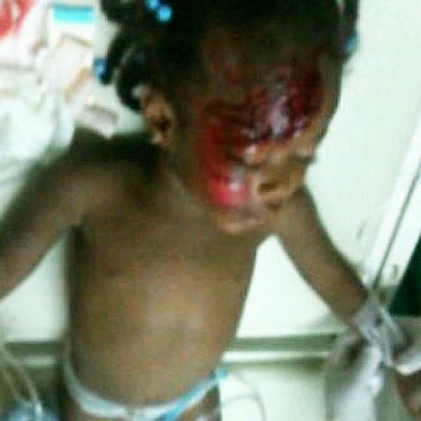 Niña herida por la represión de la Policía Nacional en Cotuí